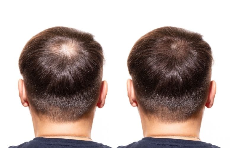 How to Regrow Hair on Bald Spot Fast- Wimpole Clinic